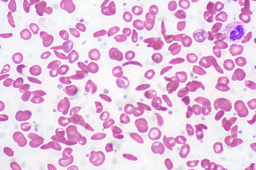 blood cells with sickle cell anemia